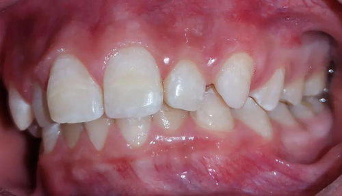 儿童牙齿清洁法宝 牙间隙色素清除有妙招